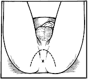 line drawing showing where incision is made for perineal approach
