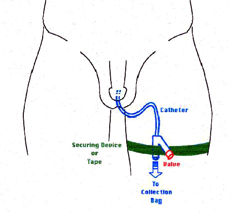 line drawing showing how to tape the catheter