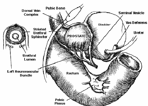 Figure 1 of the nerve-sparing radical retropubic prostatectomy RRP technicque of Dr. Patrick Walsh