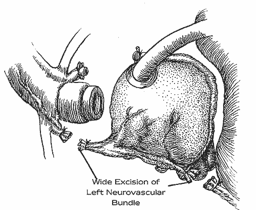 first half of Figure 6 of the nerve-sparing radical retropubic prostatectomy RRP technicque of Dr. Patrick Walsh
