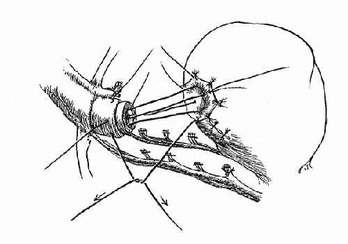 Figure 8 of the nerve-sparing radical retropubic prostatectomy RRP technicque of Dr. Patrick Walsh