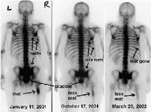 side by side comparison of 3 bone scans