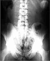 x-ray film of a pelvis