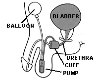 diagram of an artificial urinary sphincter made by AMS