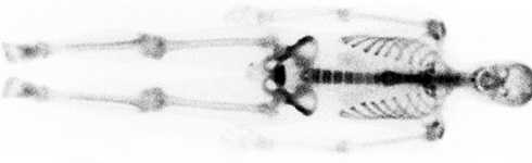 example of a bone scan film result