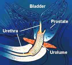 drawing showing urolume in place