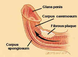 drawing showing how scar tissue creates penile bend with peyroni's disease