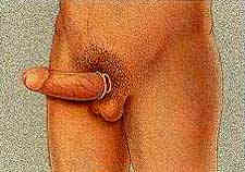 tube is removed, showing an erect penis