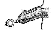 muse applicator and showing how it is inserted into the penis